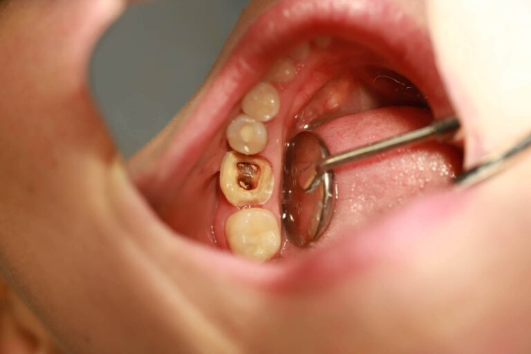 Endokorona 2 - przed