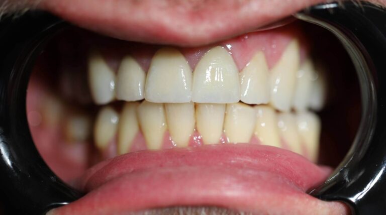 Kompleksowe leczenie wszystkich zębów - po