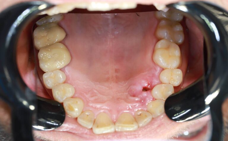 Komplesowe leczenia pacjenta z hiperdoncją - po