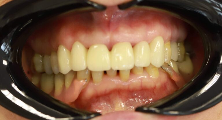 Leczenie paradontozy + korony - po