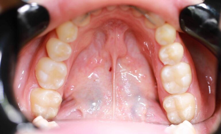 Leczenie próchnicy - po