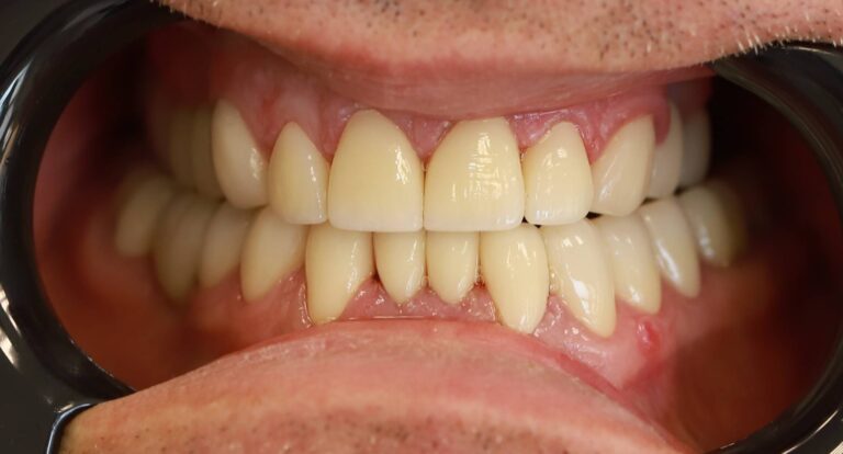 Metmorfoza uśmiechu 2 - po