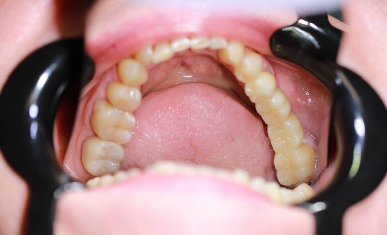 Most protetyczny - po