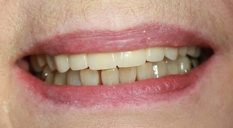 Proteza na zasuwach - po