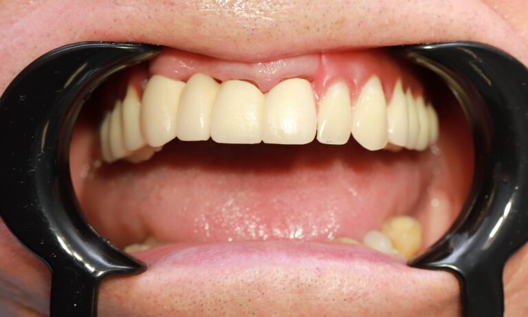 Proteza oparta na teleskopach - po