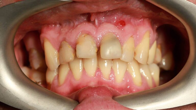 Kompleksowe leczenie wszystkich zębów - przed