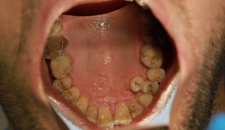 Komplesowe leczenia pacjenta z hiperdoncją - przed