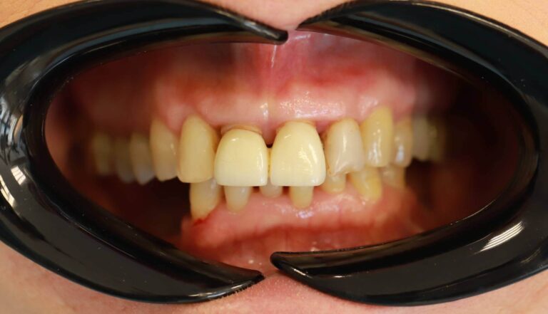 Leczenie paradontozy + korony - przed