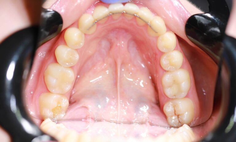 Leczenie próchnicy - przed