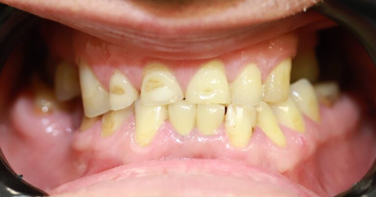 Metmorfoza uśmiechu 2 - przed