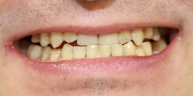 Metamorfoza uśmiechu - przed