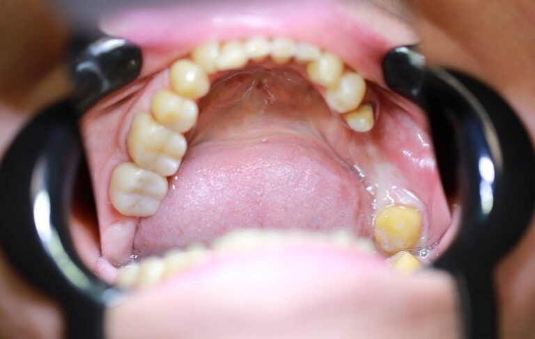 Most protetyczny - przed