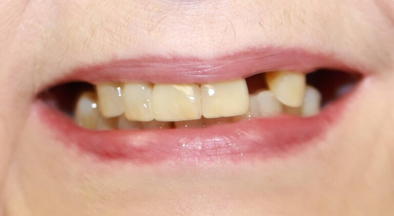 Proteza na zasuwach - przed