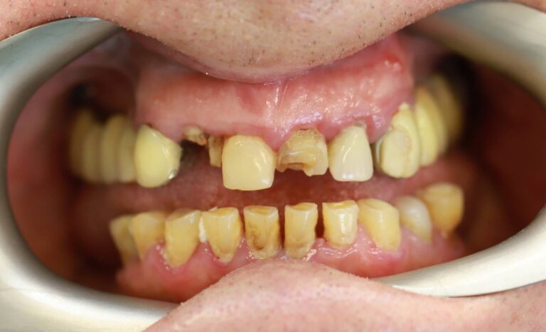 Proteza oparta na teleskopach - przed