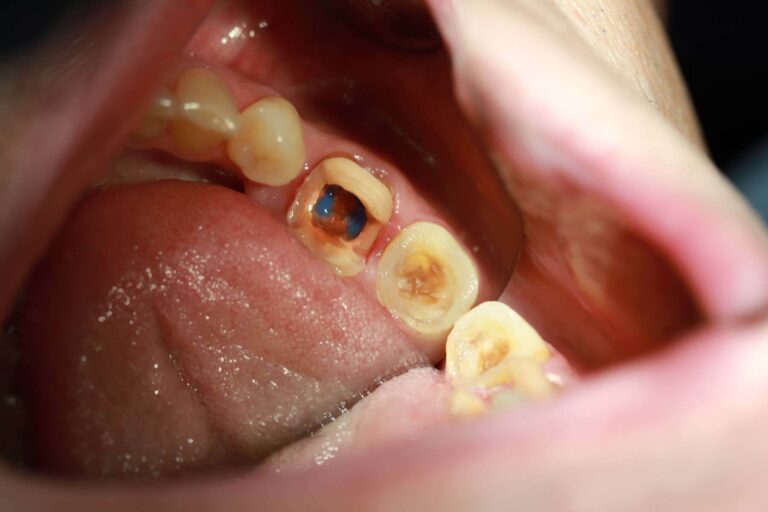 Endokorona 1 - przed